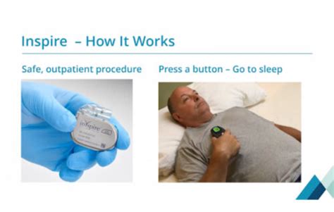helloinspire reviews|Inspire Sleep Apnea Device Review 2024 .